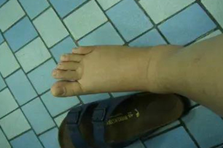 细菌感染性淋巴水肿脚部水肿图 细菌感染性淋巴水肿脚部水肿图