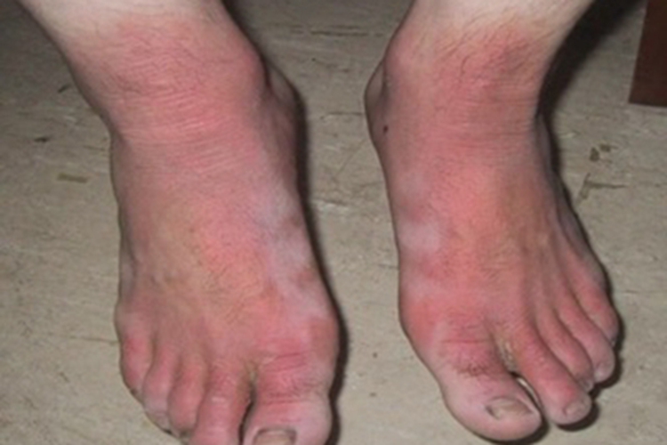 肢端青紫症脚背症状图 肢端青紫症脚背症状图