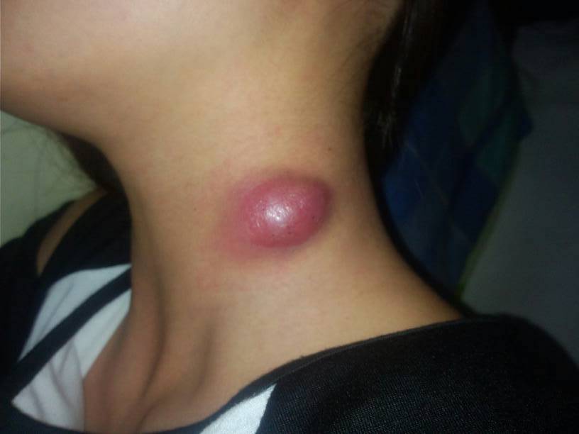 寻常型脓疱疮图