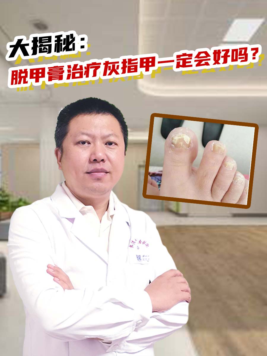 大揭秘：脱甲膏治疗灰指甲一定会好吗？