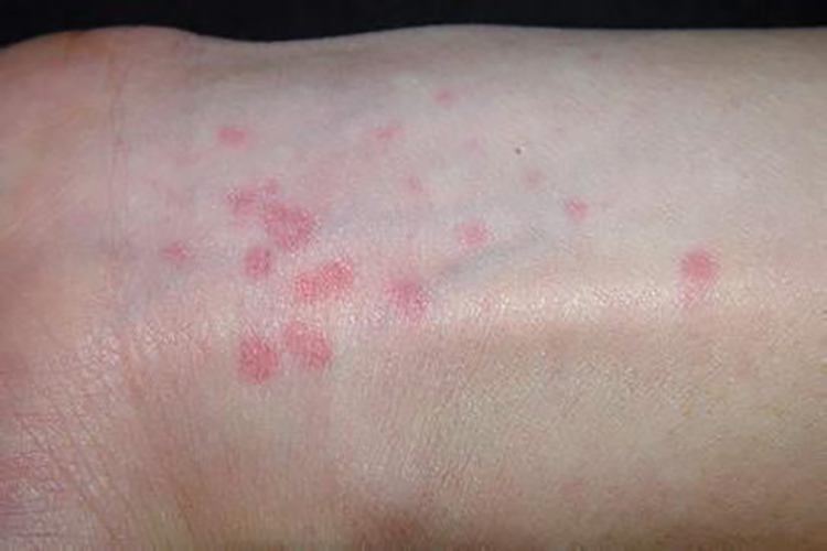 延迟压力性荨麻疹图