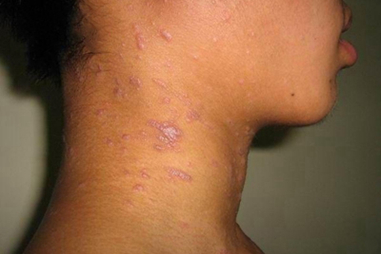 光化性扁平苔藓侧颈症状图 光化性扁平苔藓侧颈症状图