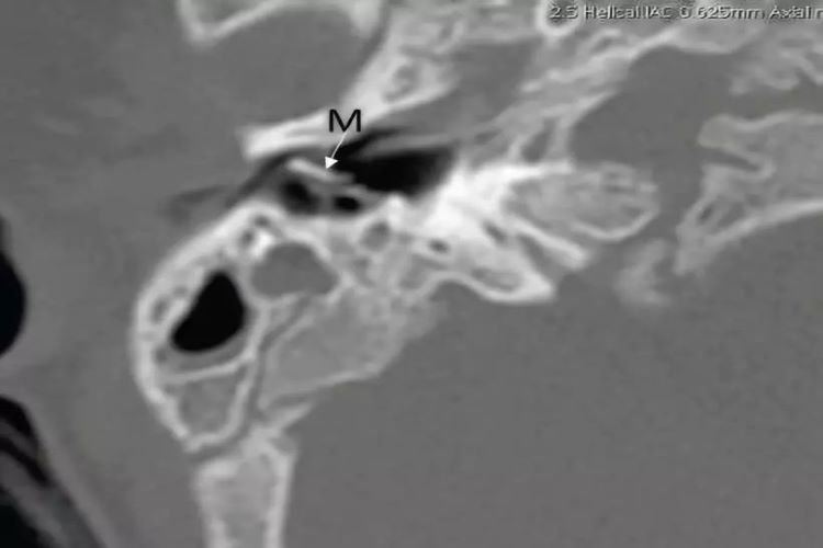 内耳畸形影像图