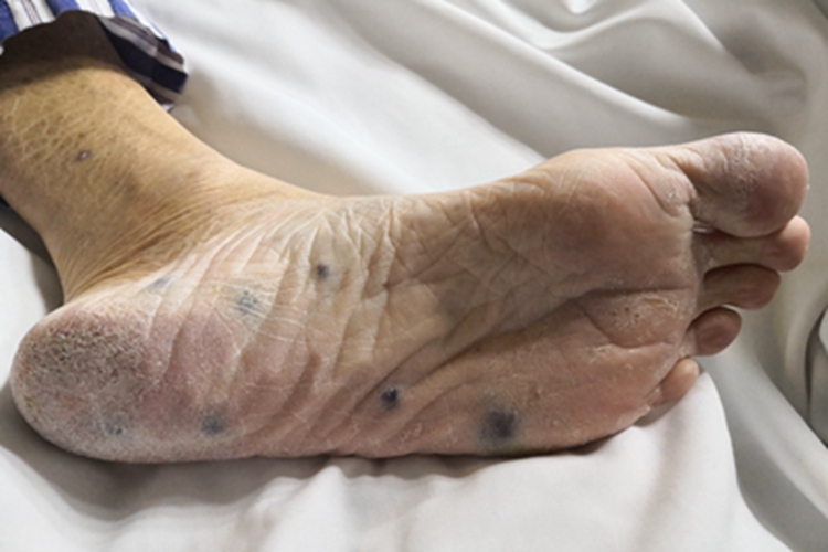 蓝色橡皮疱样痣脚底长斑图