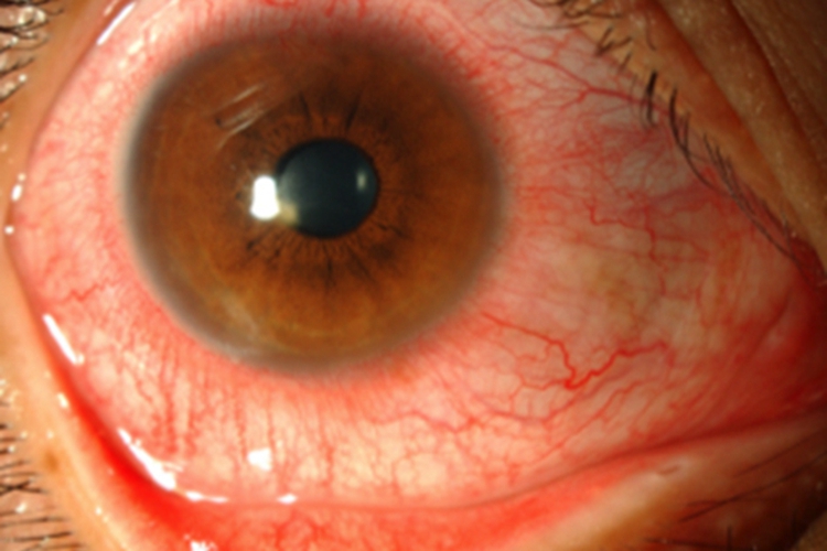 急性细菌性结膜炎图 急性细菌性结膜炎图