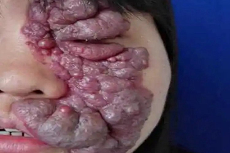 静脉畸形面部疙瘩图 静脉畸形面部疙瘩图