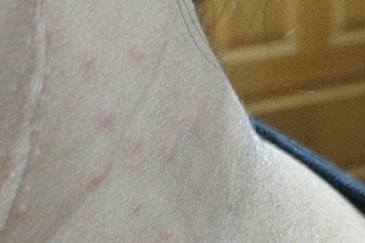 丘疹性荨麻疹侧颈疙瘩图 丘疹性荨麻疹侧颈疙瘩图