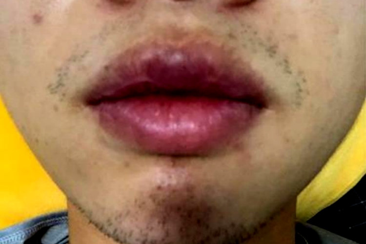 嘴唇增生图