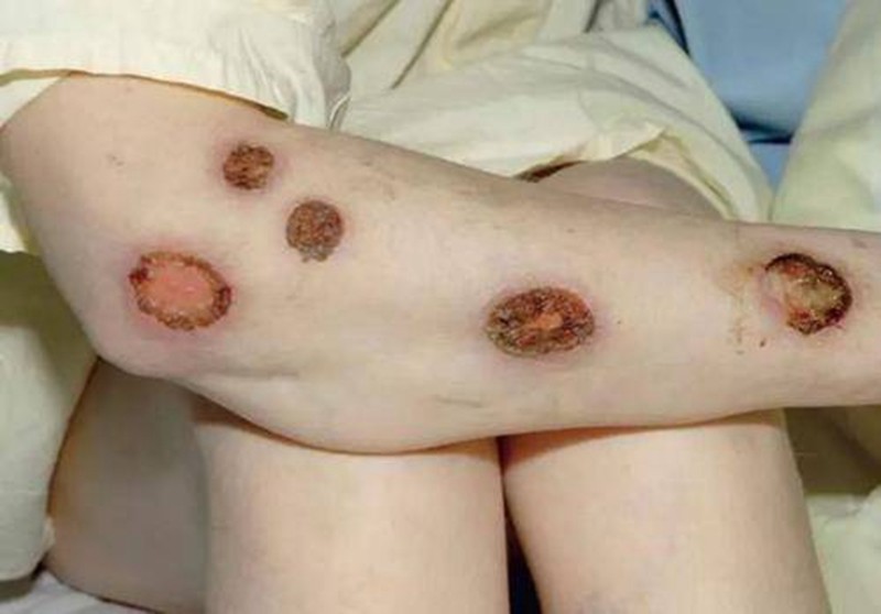女性梅毒症状图片图片