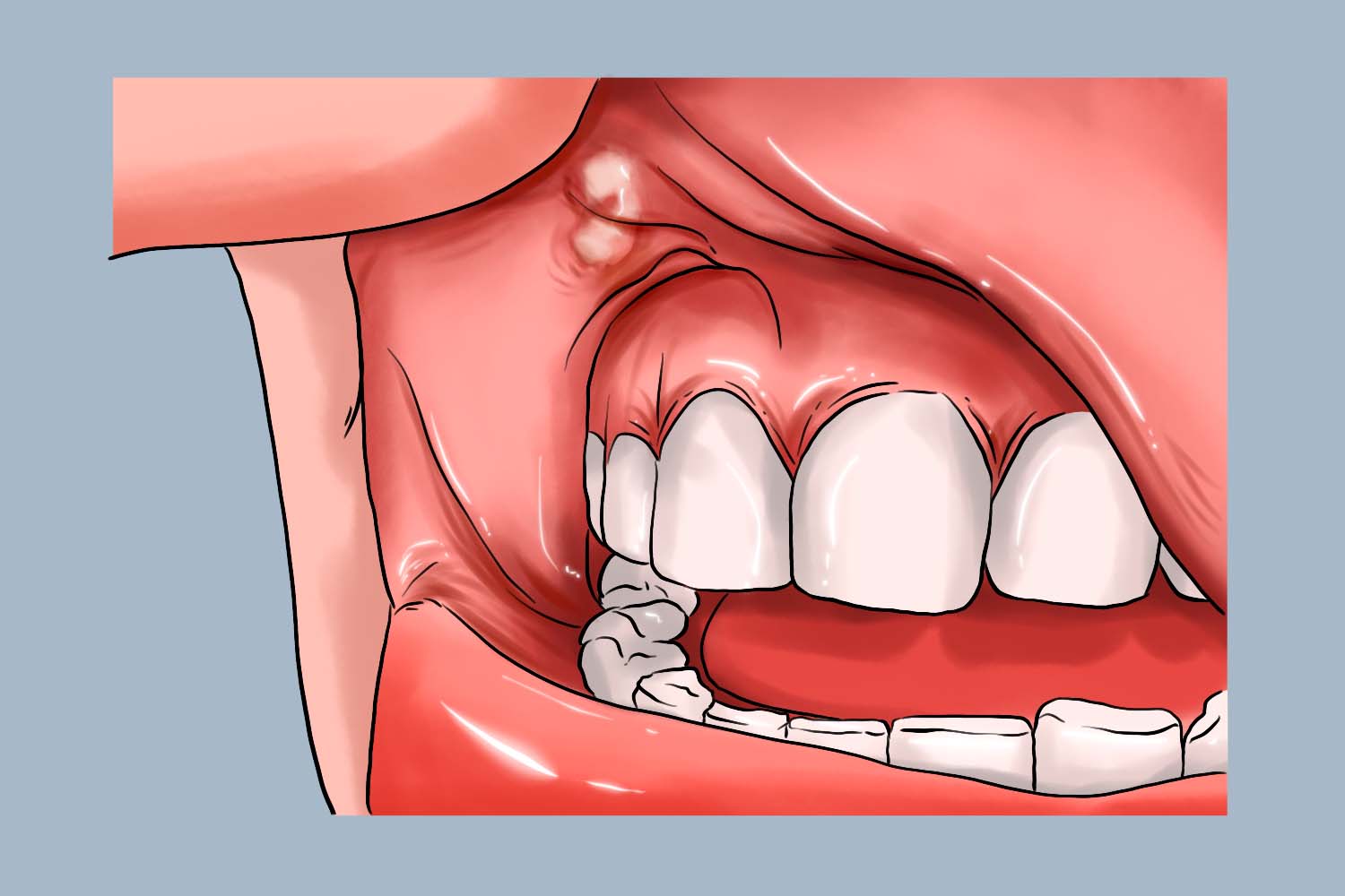 上嘴唇里边尖锐湿疣图
