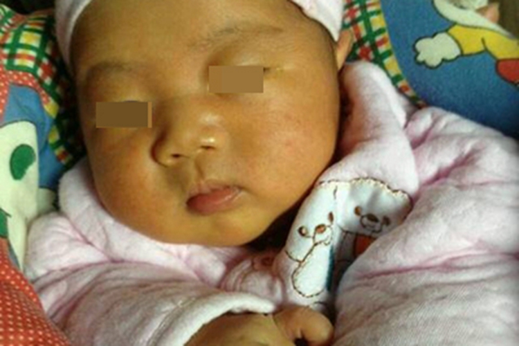 维生素E缺乏症面部症状图 维生素E缺乏症面部症状图