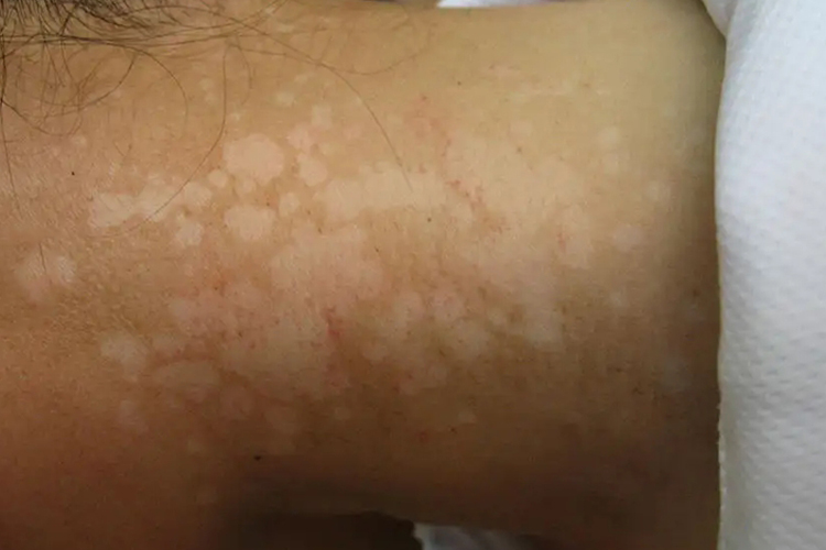 颈部花斑糠疹白点点图