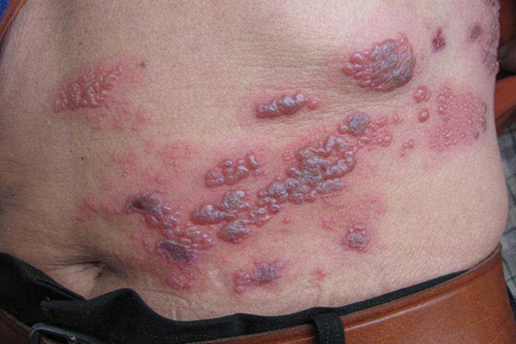 肚子带状疱疹图 肚子带状疱疹图
