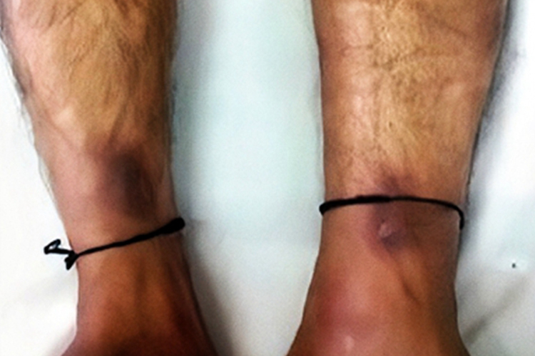 硬化性脂膜炎脚踝皮肤颜色加深图 硬化性脂膜炎脚踝皮肤颜色加深图