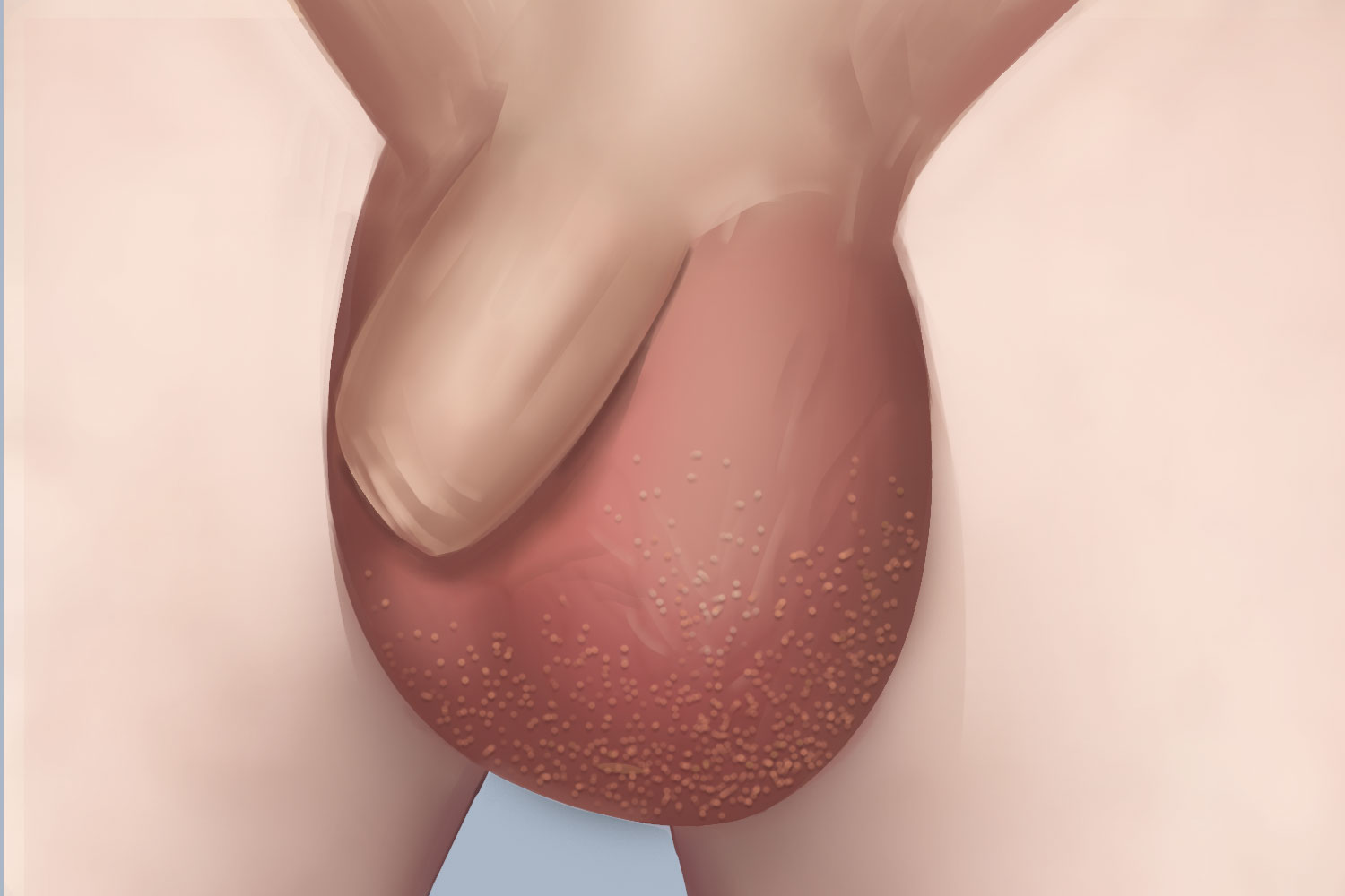 阴囊皮脂腺异位症图