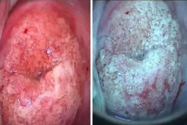 重度宫颈柱状上皮异位图