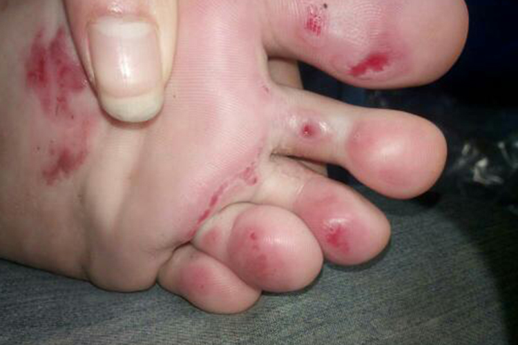 外伤导致脚底板呈紫色淤血图