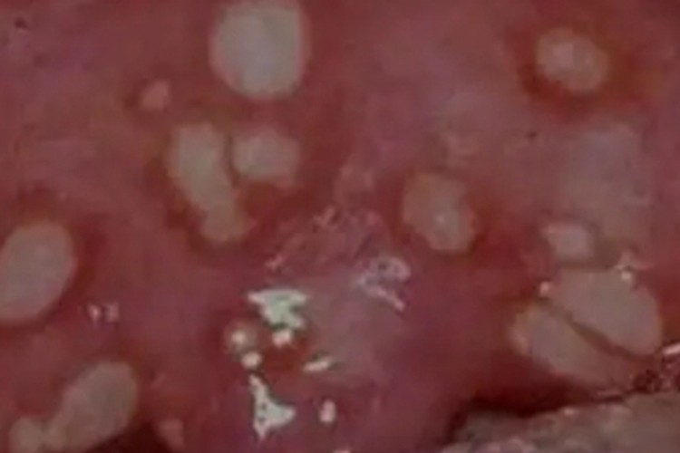 白塞病晚期图 白塞病晚期图