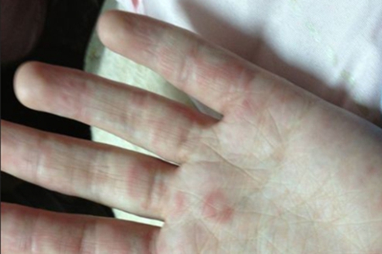 盘状红斑狼疮手掌淡红色斑图 盘状红斑狼疮手掌淡红色斑图