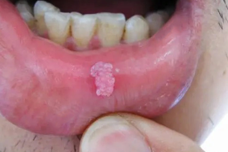 嘴唇里乳头状瘤有蒂图 嘴唇里乳头状瘤有蒂图