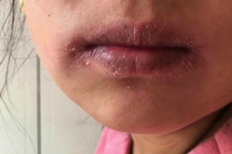 急性光化性唇炎嘴唇症状图