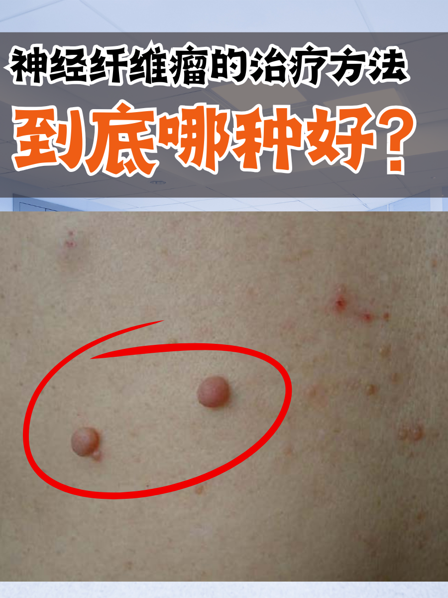 神经纤维瘤的治疗方法,到底哪种好?