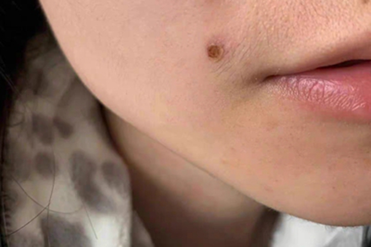 复合痣黑痂图 复合痣黑痂图