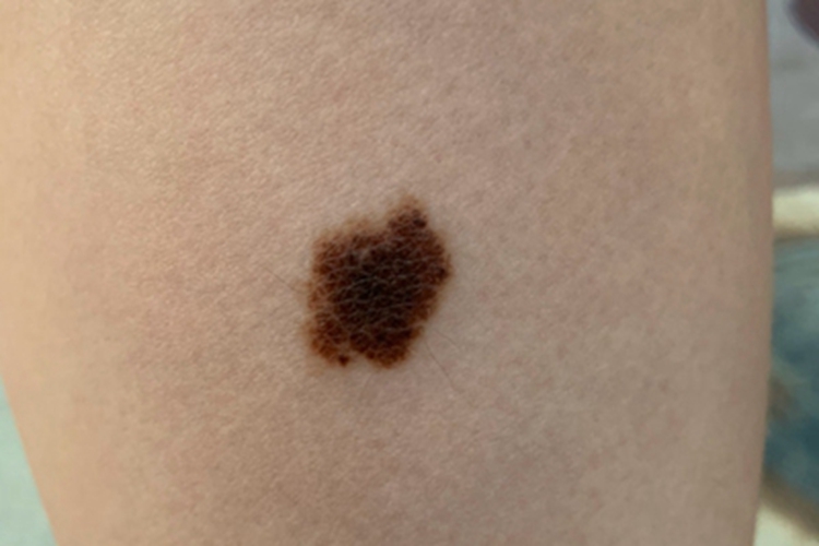 交界痣小腿长斑图