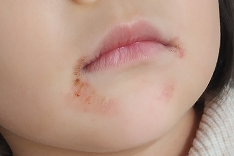 口周皮炎口周红斑结痂图