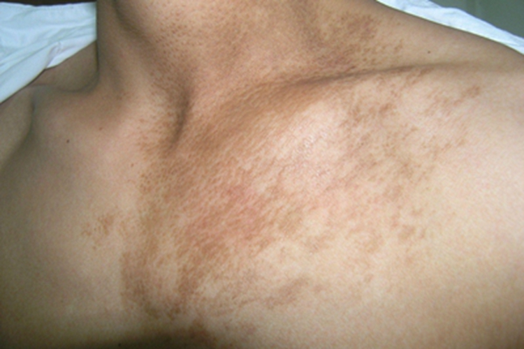 表皮痣胸部斑图