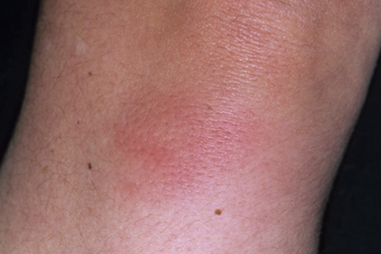 硬红斑肘部片状肿块图