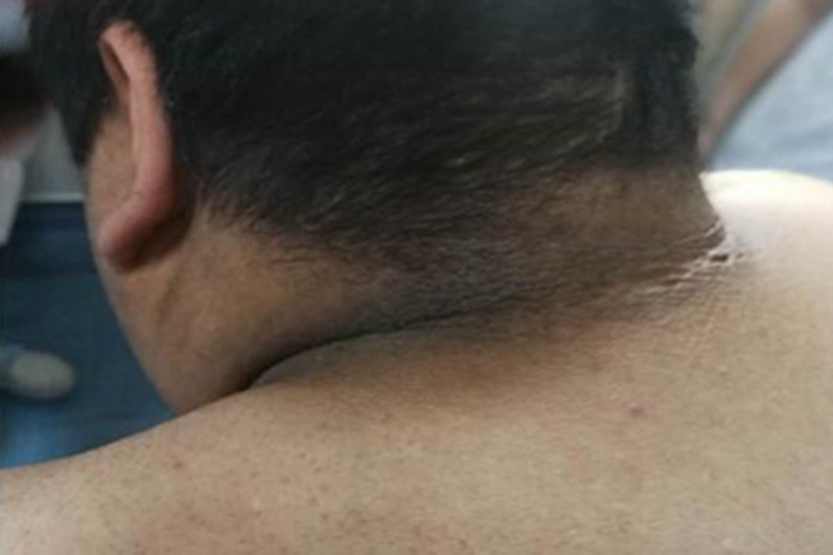 假性黑棘皮病后颈皮肤发黑图 假性黑棘皮病后颈皮肤发黑图