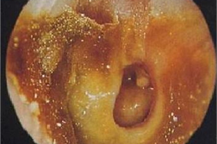 慢性化脓性中耳炎耳部症状图 慢性化脓性中耳炎耳部症状图