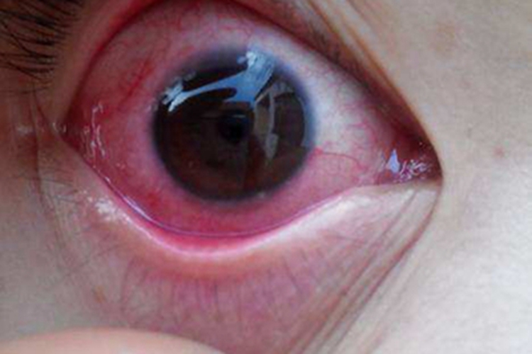 眼睑淋病结膜红肿图