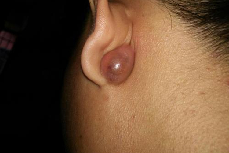 耳部皮脂腺囊肿图