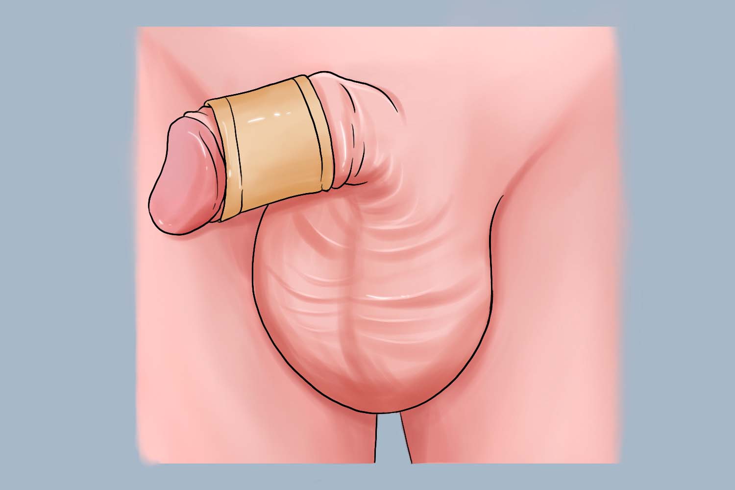 术后加压包扎图