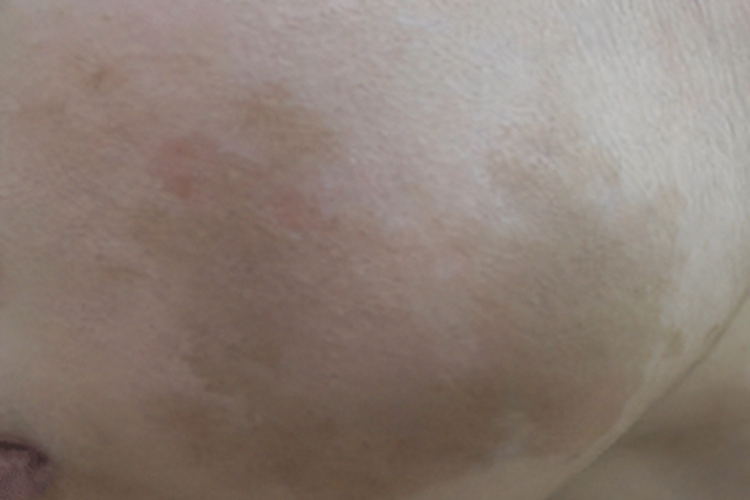 奥尔布赖特综合征脸上有褐斑图 奥尔布赖特综合征脸上有褐斑图