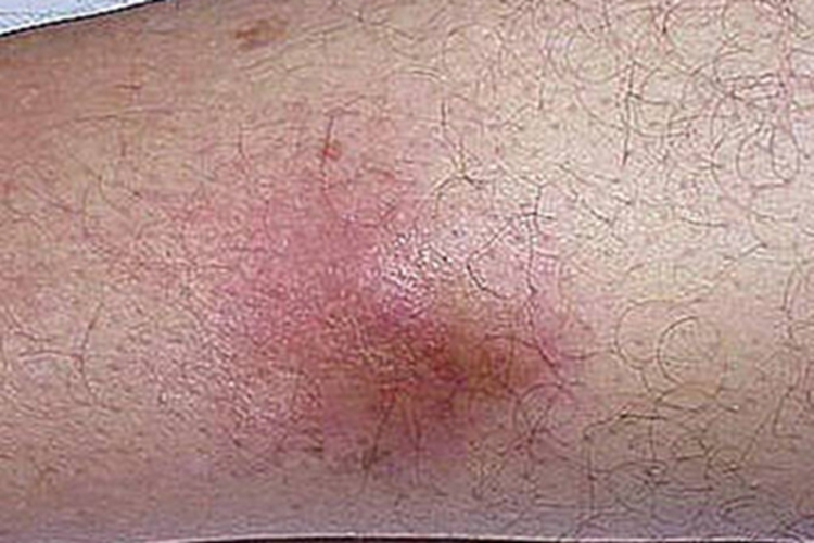 瘰疬性皮肤结核大腿结节图