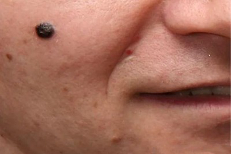 恶性黑色素瘤面部丘疹图 恶性黑色素瘤面部丘疹图