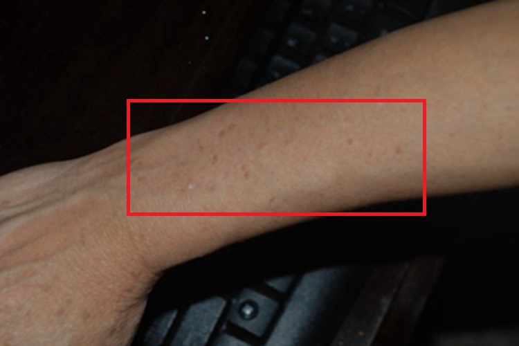 网状肢端色素沉着胳膊症状图