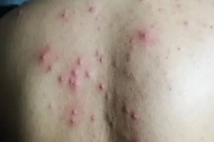 热带痤疮背部症状图