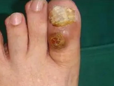 黏液样囊肿大脚趾红肿结痂图.jpg