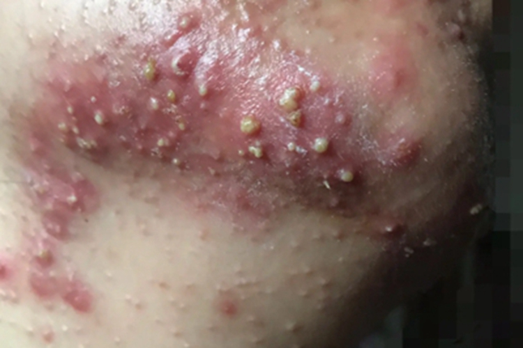 超级严重的痤疮图