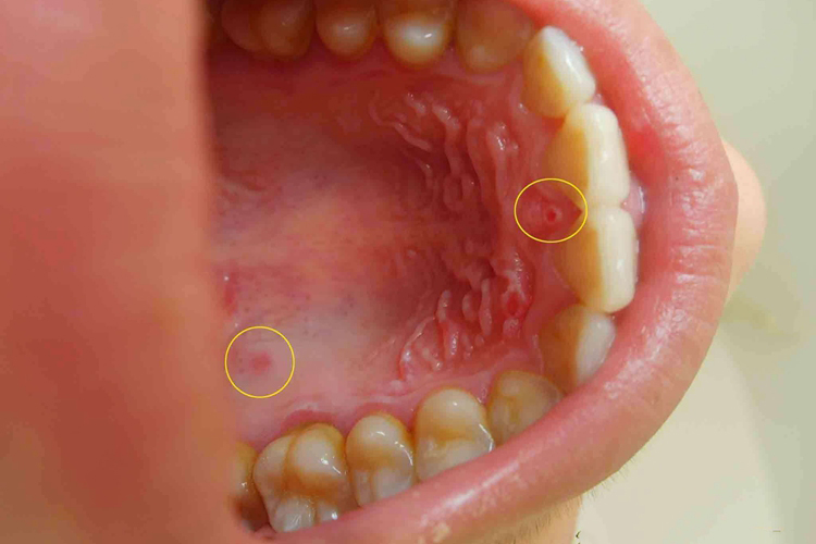 成人手足口口腔症状图 成人手足口口腔症状图