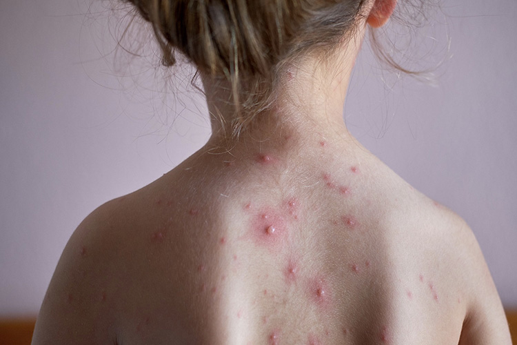 水痘初期疱疹图