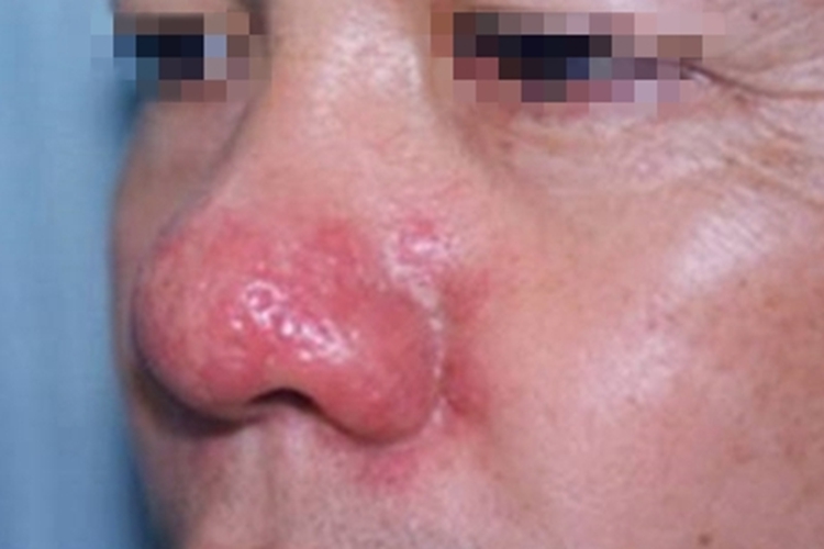 丘疹脓疱型酒糟鼻红斑图