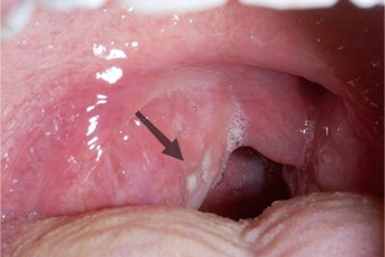化脓性扁桃体炎红肿图