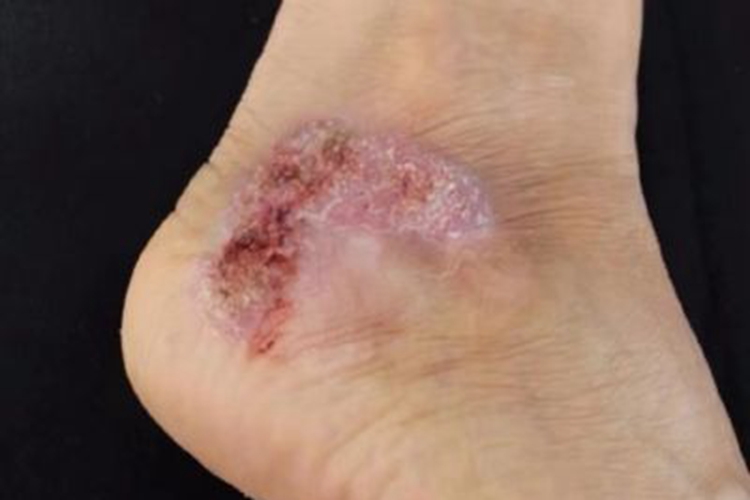 着色芽生菌病脚踝溃疡图