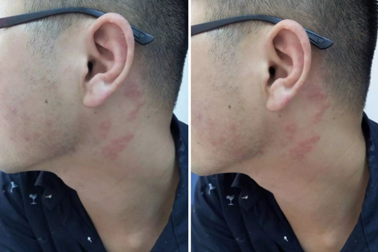 耳后体癣红斑图