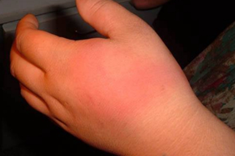 蜂窝织炎手背红肿发热图